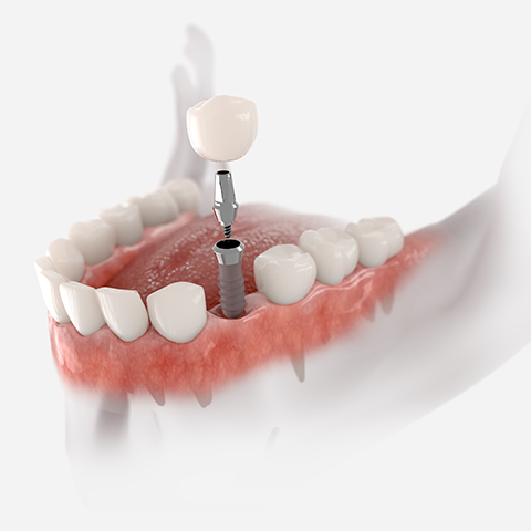 Dental Implants Treatment