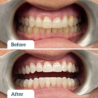 Before & After by Dr Chris Karikios