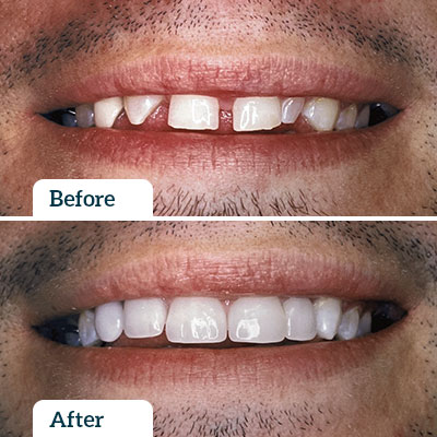 Before & After | Dental Veneers by Dr Nadine Samir