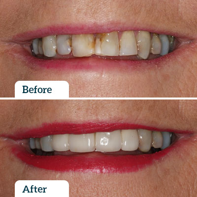 Before & After | Dental Veneers by Dr Nadine Samir