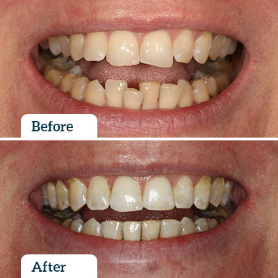 Before & After | Invisalign by Dr Nadine Samir