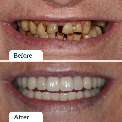 Before & After | Dental Implant by Dr Nadine Samir