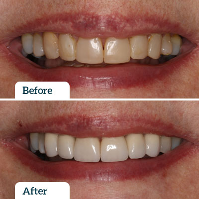 Before & After | Dental Crown by Dr Nadine Samir