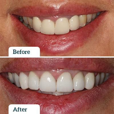 Before & After | Dental Crown by Dr Nadine Samir