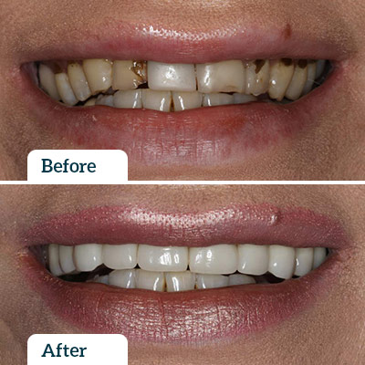 Before & After | Dental Veneers by Dr Nadine Samir