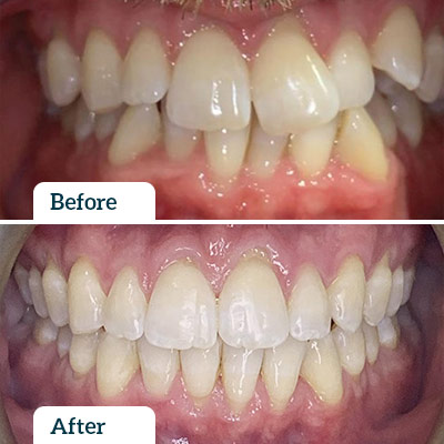 Before & After | Invisalign by Dr Nadine Samir