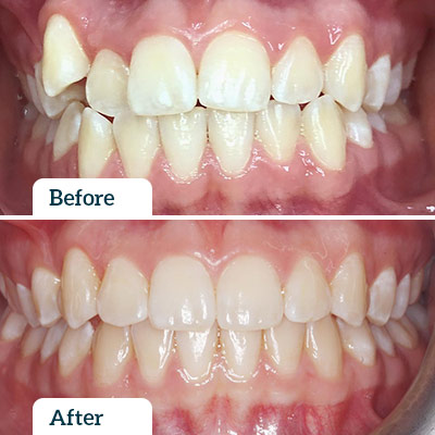 Before & After | Invisalign by Dr Nadine Samir