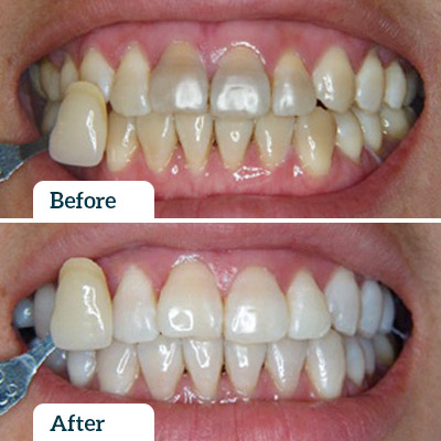 Before & After | Teeth Whitening