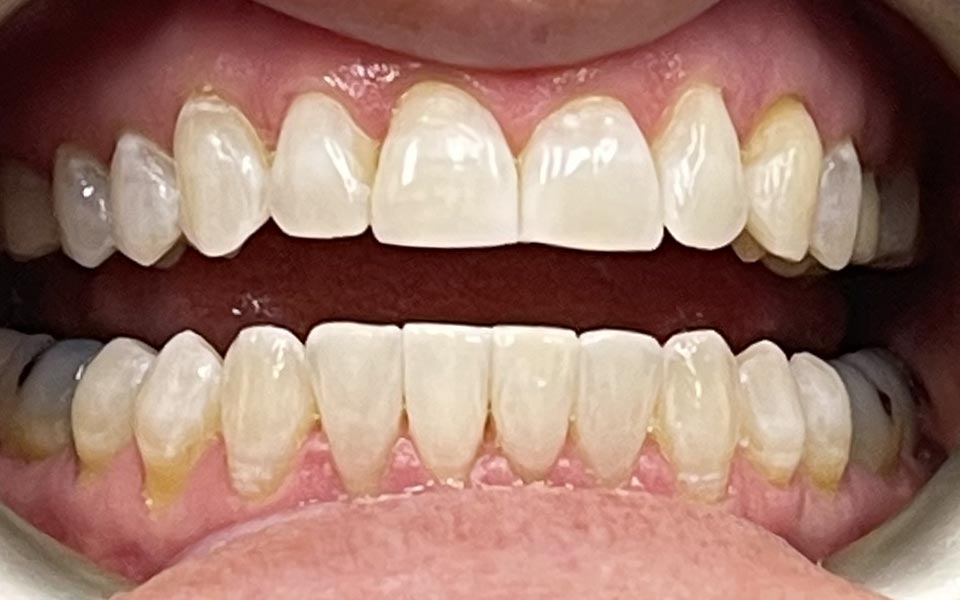 Teeth Whitening | After