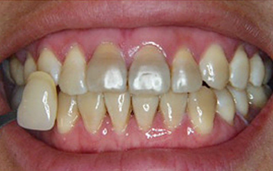 Teeth Whitening | Before